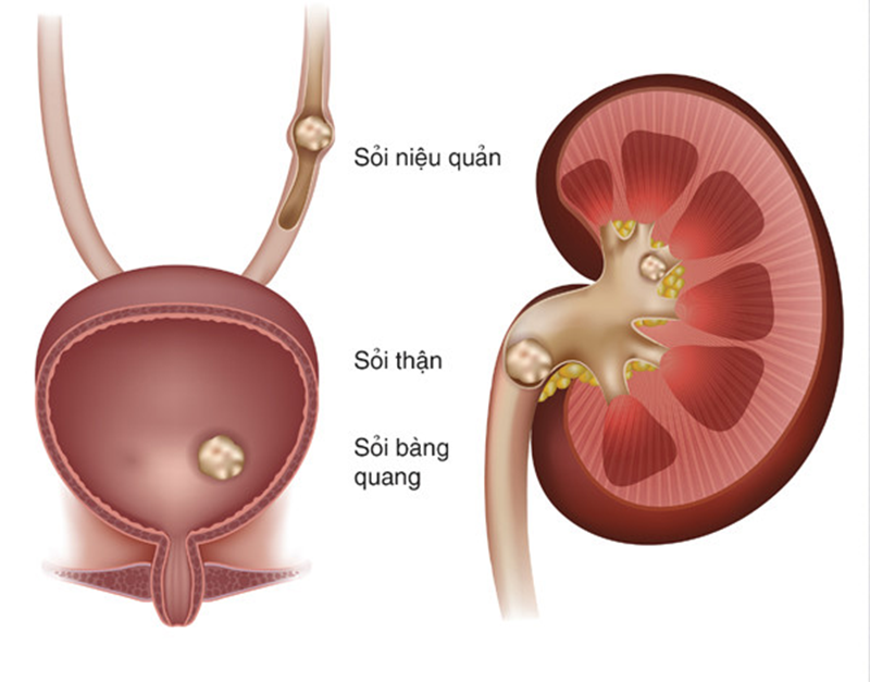 Ứ đọng nước tiểu có thể gây sỏi tiết niệu