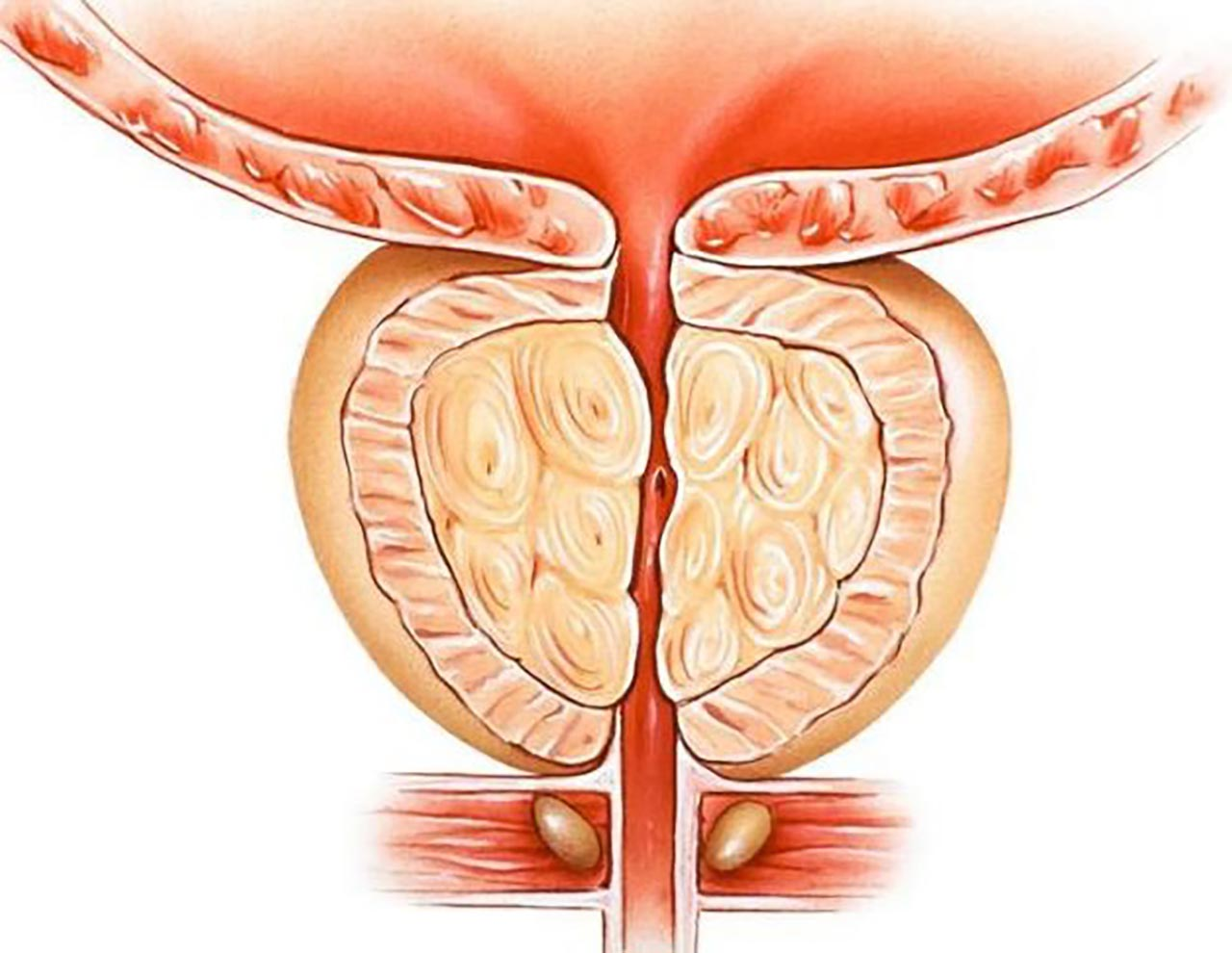 Nguyên nhân hàng đầu gây bệnh phì đại tuyến tiền liệt là gì?