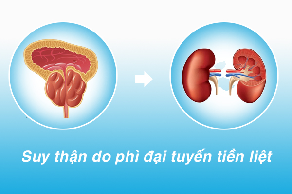 Phòng ngừa biến chứng suy thận do phì đại tuyến tiền liệt bằng cách nào?