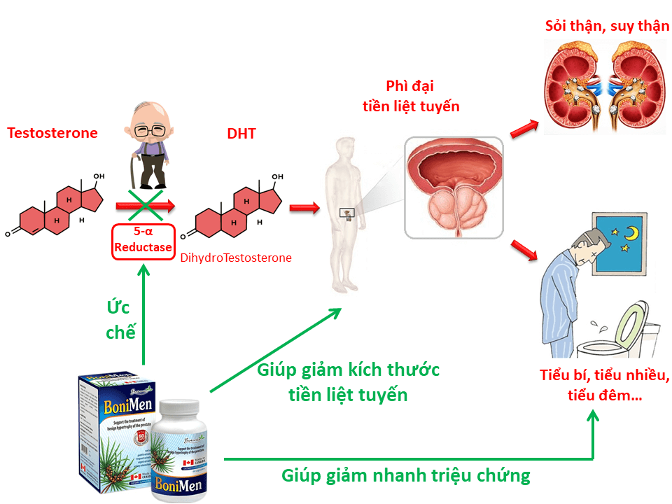 BoniMen - giải quyết từ nguyên nhân phì đại tiền liệt tuyến