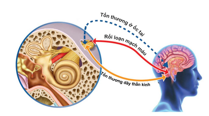  Căng thẳng do thức khuya, mất ngủ làm máu không vận chuyển oxy lên não gây chết tế bào ốc tai