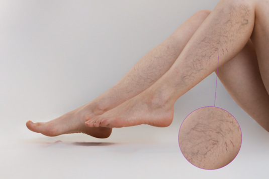 Kết quả hình ảnh cho Varicose veins