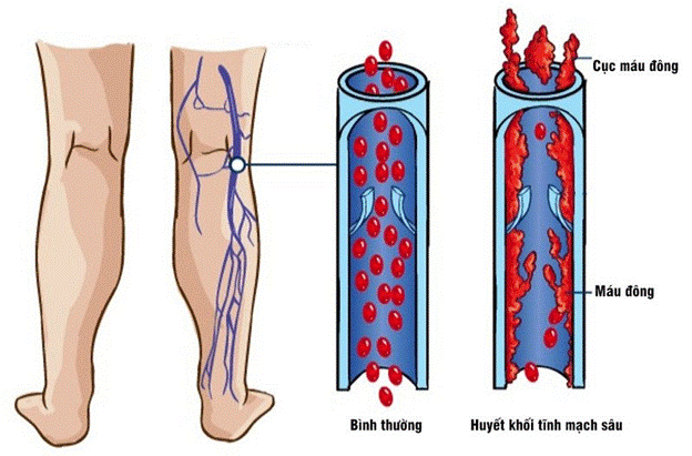 Biến chứng huyết khối tĩnh mạch sâu do suy van tĩnh mạch sâu