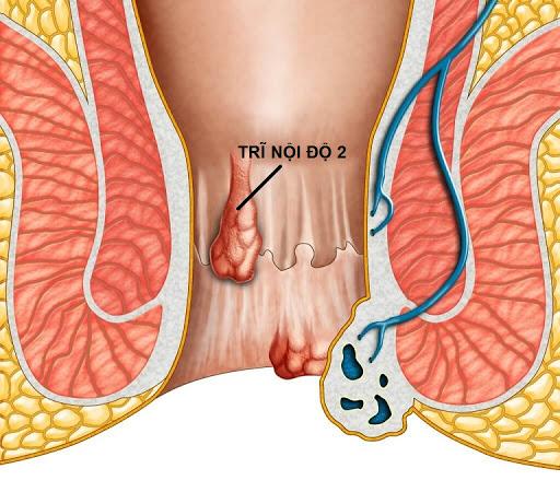 BoniVein có cải thiện được trĩ nội độ 2