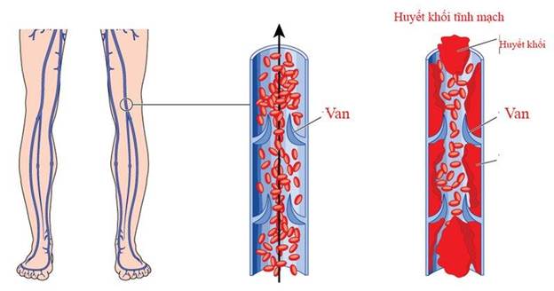 Biến chứng huyết khối tĩnh mạch sâu