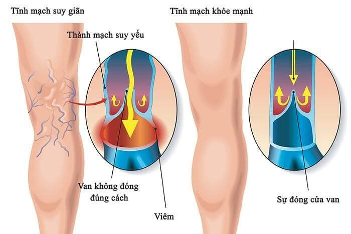 Suy van tĩnh mạch là gì