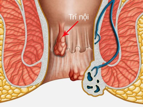 Bệnh trĩ nội độ 2 là gì?