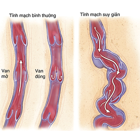 3 Cách điều trị suy giãn tĩnh mạch sâu phổ biến