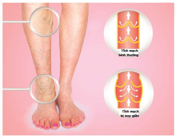 Cách chữa bệnh suy giãn tĩnh mạch chân là gì? Đâu là giải pháp tối ưu?