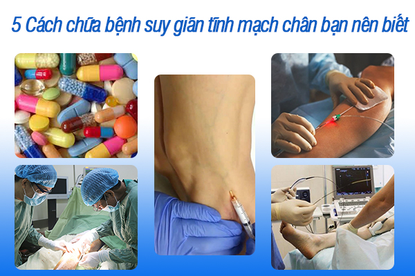 5 Cách chữa bệnh suy giãn tĩnh mạch chân bạn nên biết