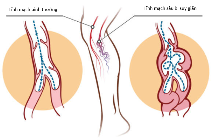 Suy giãn tĩnh mạch sâu nguy hiểm như thế nào?