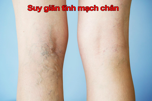 Suy giãn tĩnh mạch chân