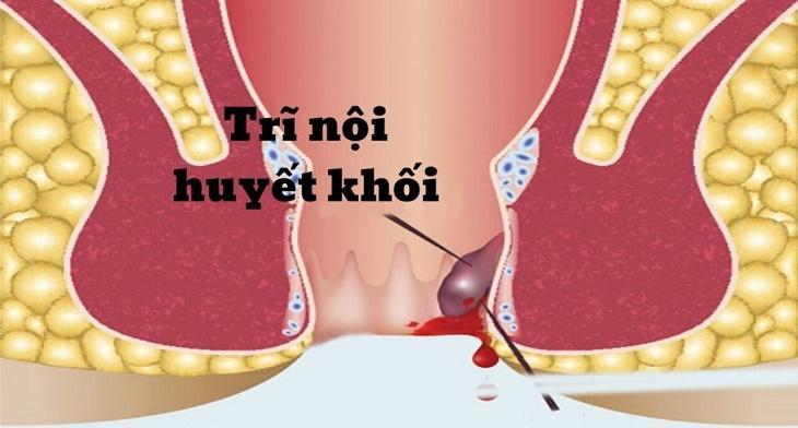 Trĩ Huyết Khối Là Gì? Cách Nhận Biết, Điều Trị Hiệu Quả