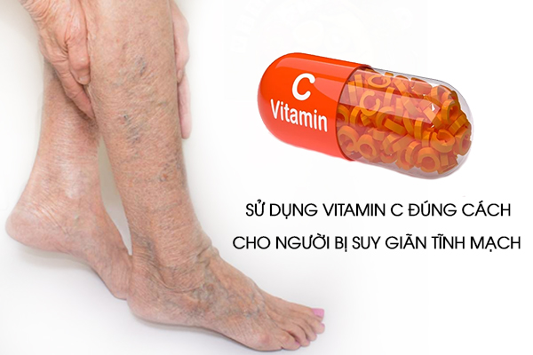 Bị suy giãn tĩnh mạch - Bạn đã sử dụng vitamin C đúng cách chưa?