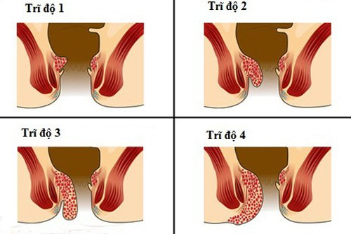 Các cấp độ trĩ nội