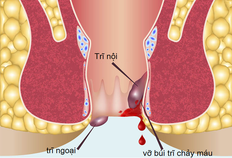 Hiện tượng vỡ búi trĩ chảy máu