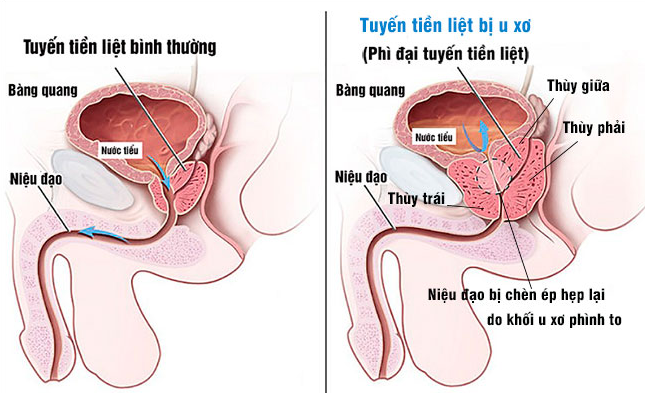 Bệnh u phì đại lành tính tuyến tiền liệt: Tất tần tật từ A→ Z