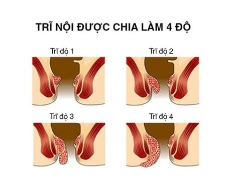 Để điều trị hiệu quả trĩ, cần phân loại bệnh 