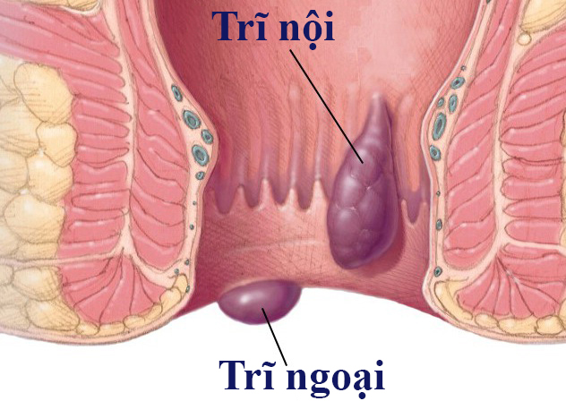 Trĩ ngoại là loại bệnh trĩ rất phổ biến