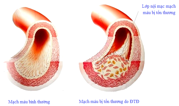 biến chứng mạch máu bệnh tiểu đường