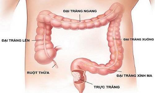 Viêm đại tràng sigma