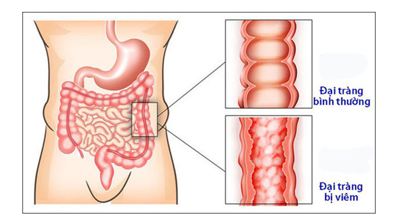 Viêm đại tràng đặc trưng bởi những ổ viêm loét hay áp xe.