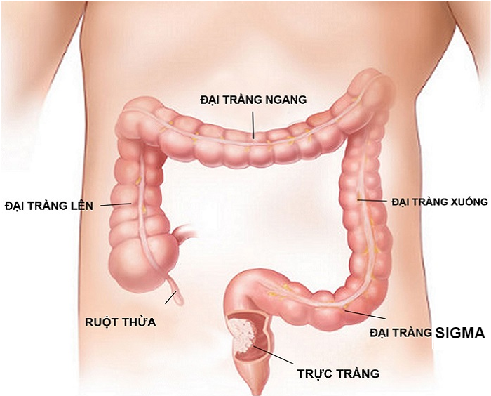 Viêm đại tràng sigma: Nguyên nhân, triệu chứng và cách khắc phục hiệu quả