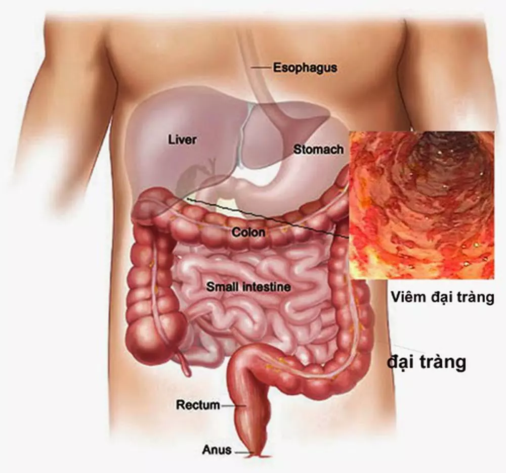 Những nguyên tắc vàng trong điều trị viêm đại tràng, bạn cần biết!