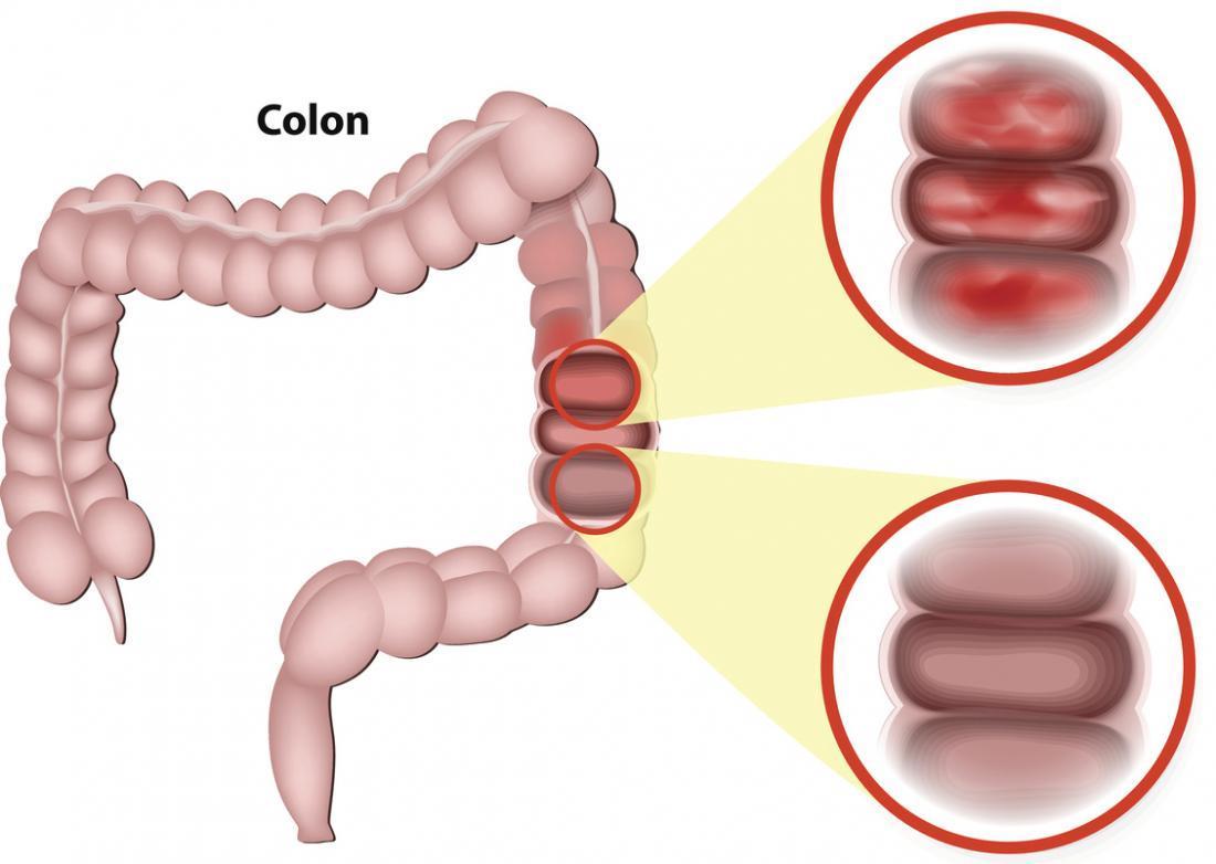 Nhận biết và phát hiện sớm bệnh viêm đại tràng rất quan trọng