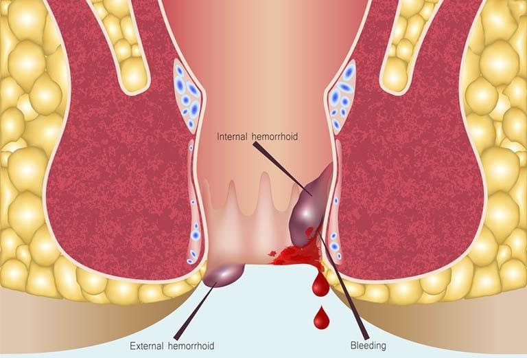 Vỡ búi trĩ chảy máu và các biện pháp điều trị