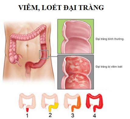 Viêm, loét đại tràng