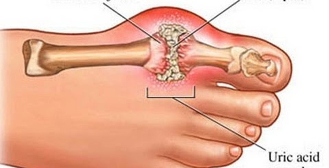 Hỏi: Bị Gút lâu năm có thể gặp những biến chứng gì ạ?