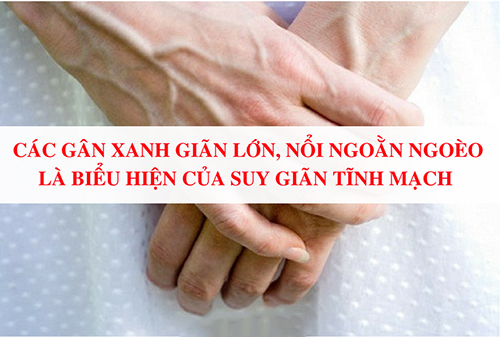 suy giãn tĩnh mạch tay