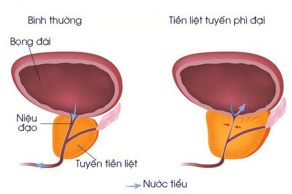 Tìm hiểu về cách chữa phì đại tuyến tiền liệt