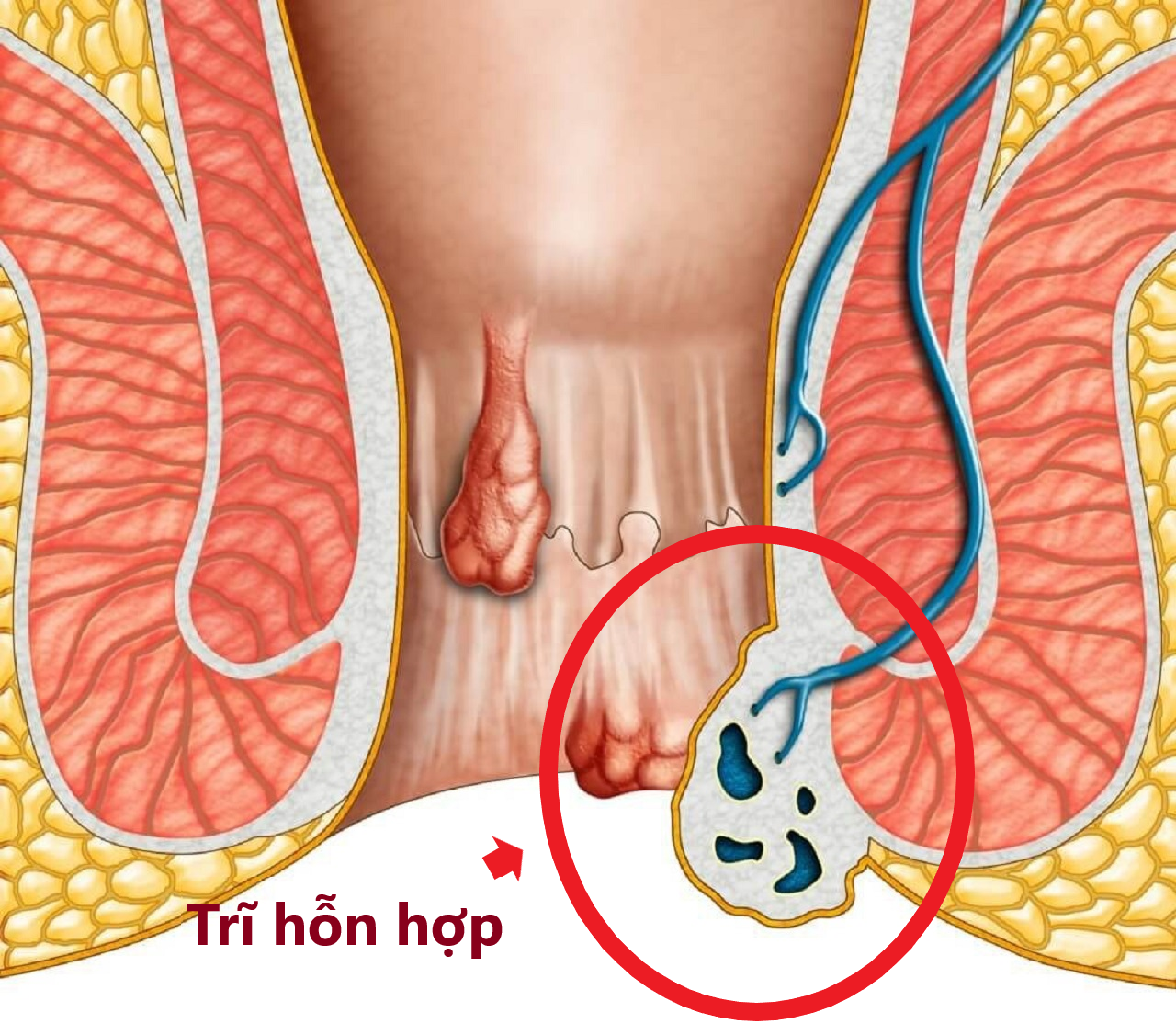 Trĩ hỗn hợp là gì?