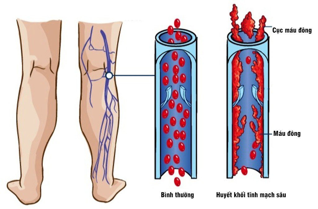 Biến chứng suy giãn tĩnh mạch - Huyết khối tĩnh mạch sâu nguy hiểm thế nào?