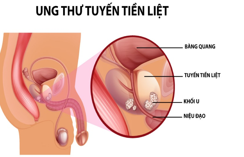  Hình ảnh khối u trong tuyến tiền liệt