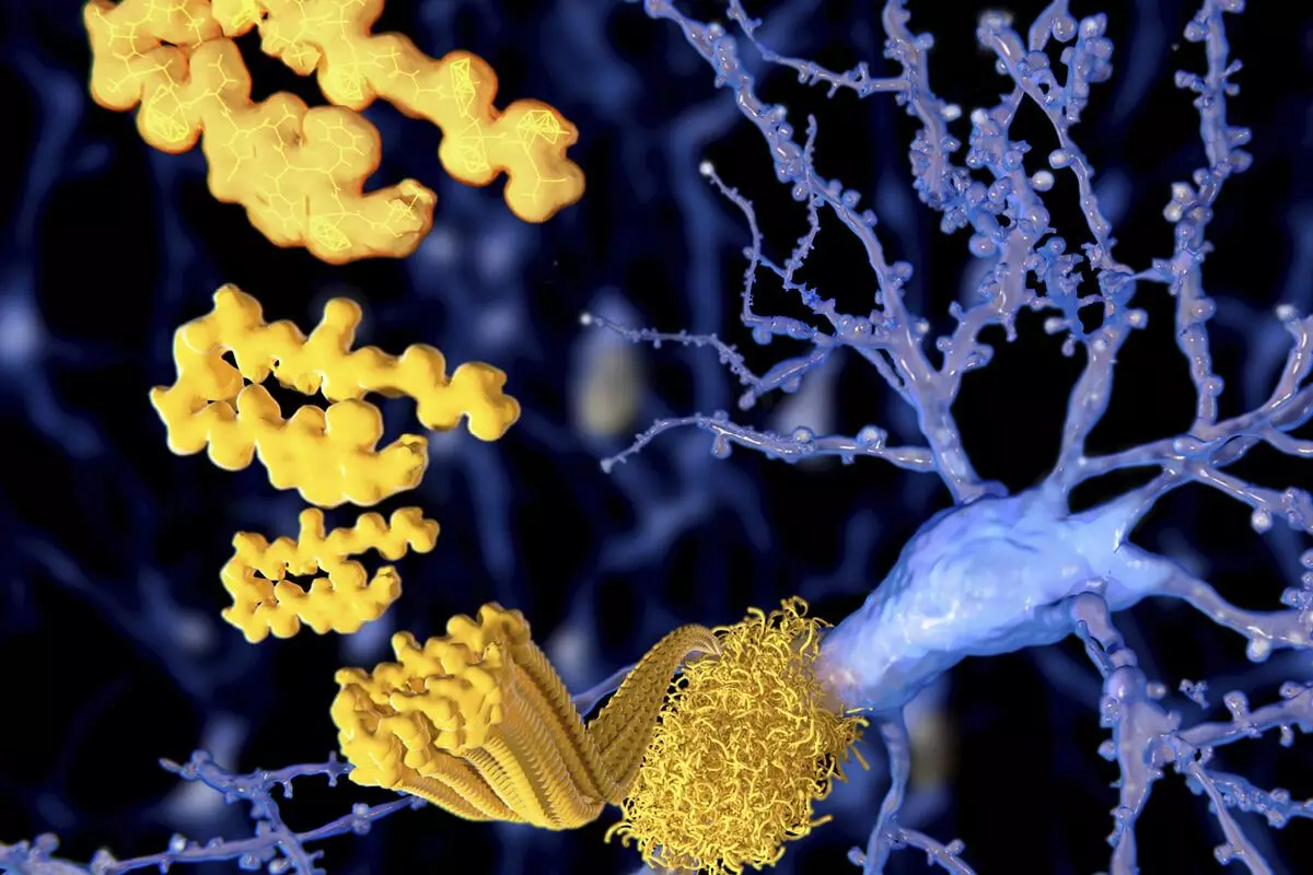 Các mảng amyloid beta