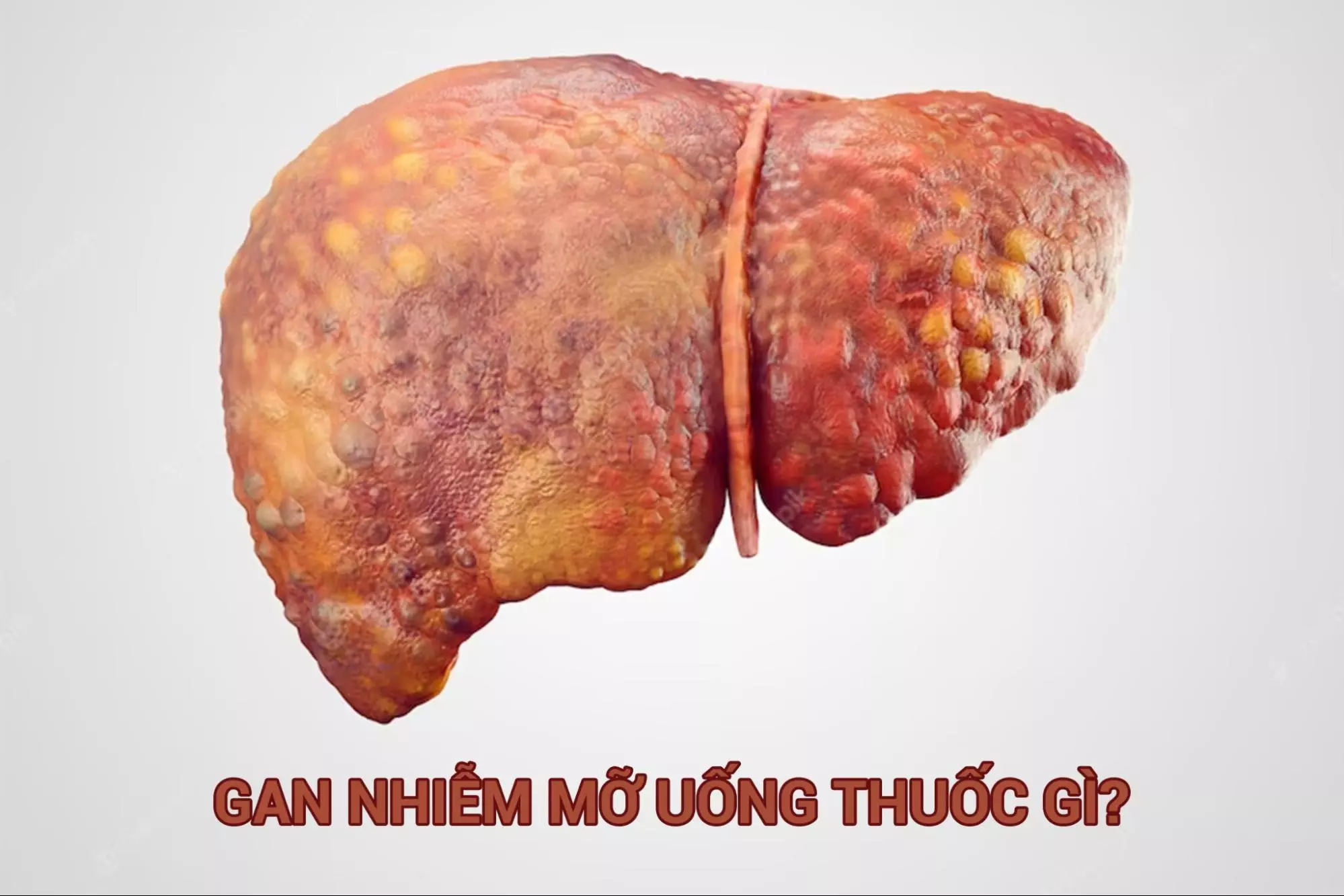 Bị gan nhiễm mỡ uống thuốc gì