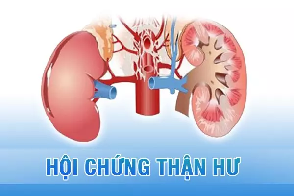 Hội chứng thận hư là bệnh gì