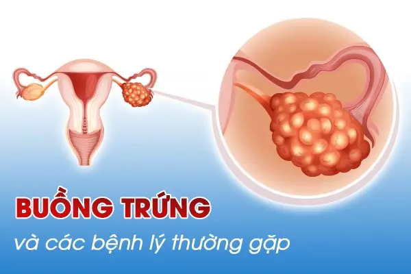 Tìm hiểu về buồng trứng