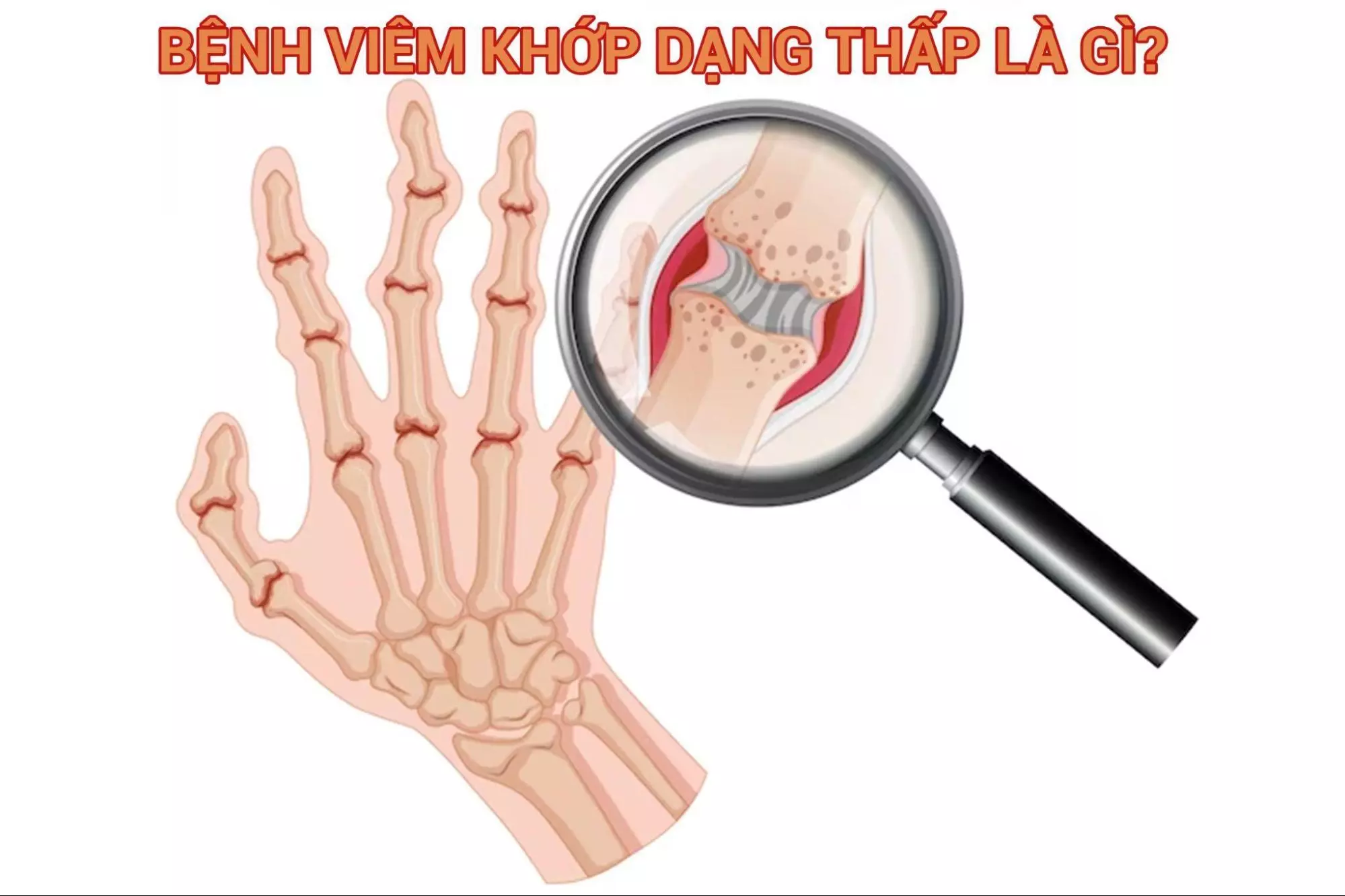 Bệnh viêm khớp dạng thấp là gì? Có nguy hiểm không?