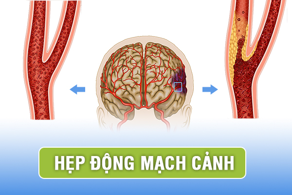 Những biến chứng nguy hiểm do hẹp động mạch cảnh và cách điều trị