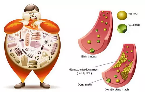 Người thừa cân, béo phì có nguy cơ cao bị hẹp động mạch cảnh