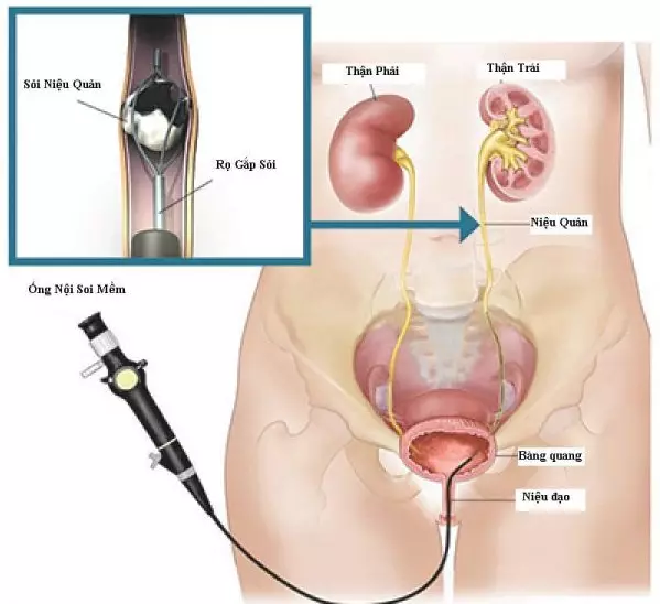  Phương pháp tán sỏi nội soi ngược dòng