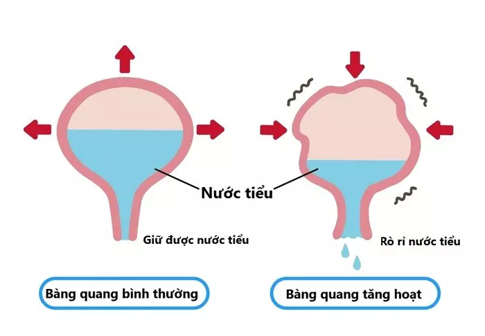 Bàng quang tăng hoạt