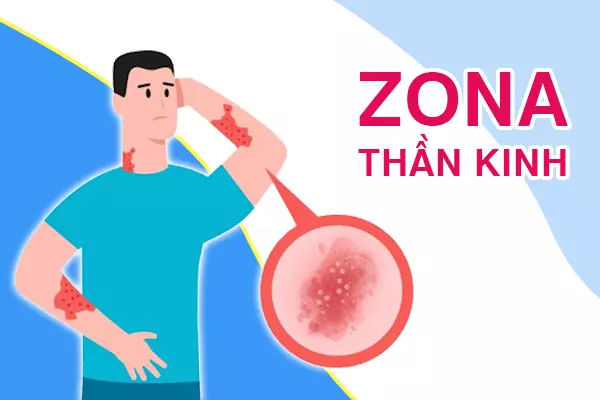 Bị zona thần kinh có nguy hiểm không?