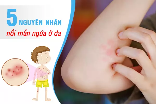 5 nguyên nhân khiến da bị nổi mẩn ngứa