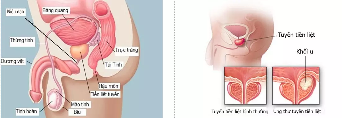 ung thư tuyến tiền liệt