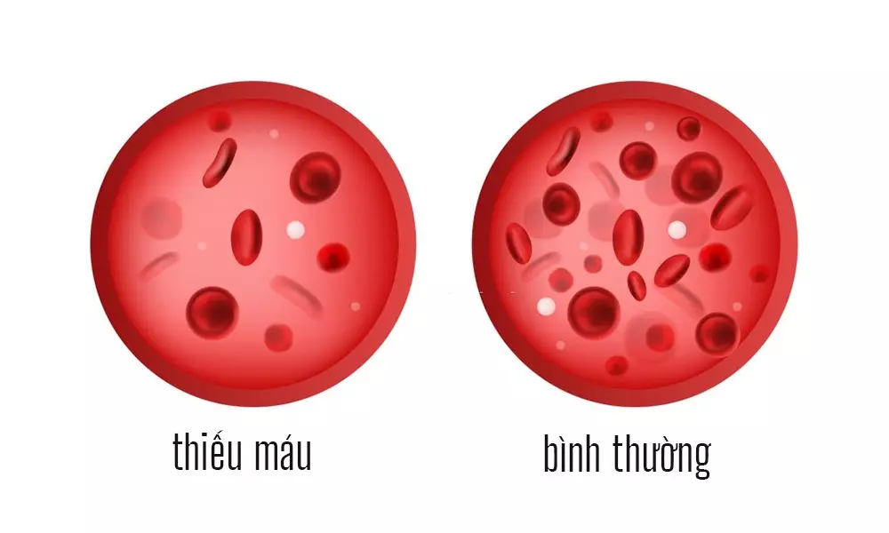 Thiếu máu